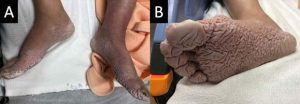 عارضه  Trench foot  را بهتر بشناسیم؟ عارضه پا سنگری را چگونه درمان کنیم؟
